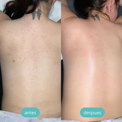 💎 LUMISKIN® ¡🔥 DI ADIÓS AL ACNÉ Y MANCHAS EN TU ESPALDA! + GRAN COMBO