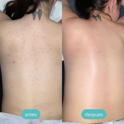 💎 LUMISKIN® ¡🔥 DI ADIÓS AL ACNÉ Y MANCHAS EN TU ESPALDA! + GRAN COMBO