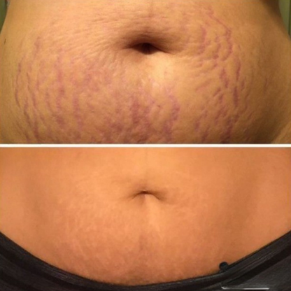 Aceite en gel para embarazo y posparto 100 ml - Disminuye estrías, Hipoalergénico y dermatológicamente probado - ¡lleva 2 unidades para 6 meses!