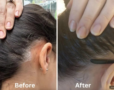 Bálsamo botánico - ayuda a calmar la caspa, la psoriasis y la dermatitis del cuero cabelludo + 50% DCT